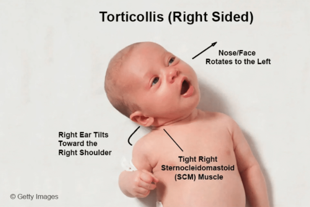 torticollis